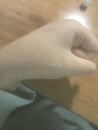 히루스카 포스트아크네 클리어 — 3점을 준 리뷰어가 2021년 1월 올린 사용 사진