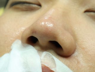 세뚜아(Cettua) 세뚜아 스티키 포어 패치 Cettua Sticky Pore Patch — 5점을 준 리뷰어가 2023년 6월 올린 사용 사진