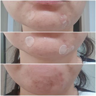 올리브영 엘라밴드 하이드로 도트 스팟패치 12mm, 티트리 — 4점을 준 리뷰어가 2022년 10월 올린 사용 사진
