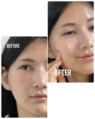 루트리 오디베리 5중 모공 리파이닝 앰플 — 5점을 준 리뷰어가 2023년 12월 올린 사용 사진