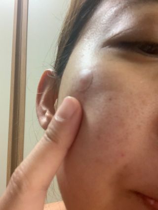 올리브영 엘라밴드 하이드로 도트 스팟패치 12mm, 티트리 — 4.5점을 준 리뷰어가 2022년 10월 올린 사용 사진