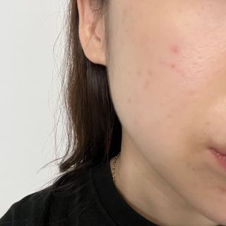 세뚜아(Cettua) 세뚜아 스팟 클리어 듀얼 패치 Cettua Spot Clear Dual Patch — 5점을 준 리뷰어가 2023년 7월 올린 사용 사진