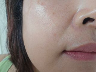 닥터초이스 [쿠팡 구매평] 황해쑥 시카엑소좀 카밍 앰플 PDRN  나이아신 IGF FGF AHA BHA 트러블케어 특허, 1개, 30g — 5점을 준 리뷰어가 2025년 5월 올린 사용 사진