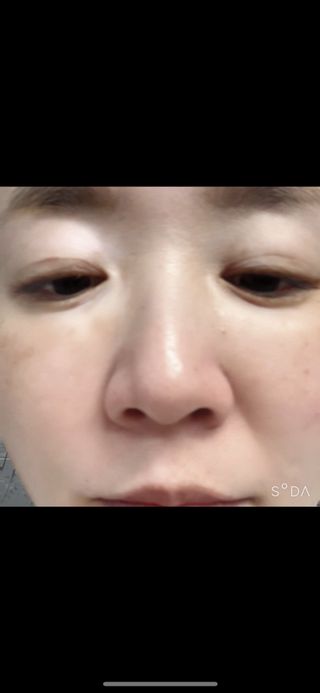 블립 ★올리브영 약산성 폼클렌징 살리실산 요철클렌징 균제거 시카 어성초 클렌징폼 [네이버 구매+인스타 리뷰] — 5점을 준 리뷰어가 2024년 12월 올린 사용 사진