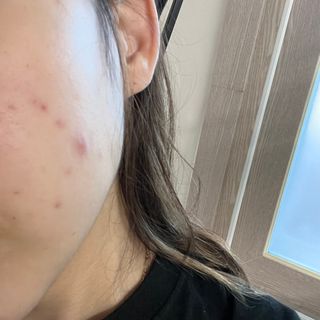 세뚜아(Cettua) 세뚜아 스팟 클리어 듀얼 패치 Cettua Spot Clear Dual Patch — 5점을 준 리뷰어가 2023년 7월 올린 사용 사진