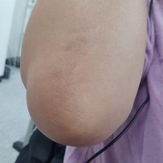 건선/아토/습진/민감성 피부 천연보습진정크림 소리온 크림 & 센시티브 크림 50g — 5점을 준 리뷰어가 2022년 1월 올린 사용 사진