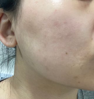 히루스카 포스트아크네 클리어 — 4점을 준 리뷰어가 2021년 2월 올린 사용 사진