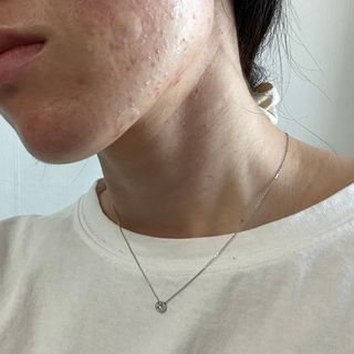 올리브영 엘라밴드 하이드로 도트 스팟패치 12mm, 티트리 — 5점을 준 리뷰어가 2022년 10월 올린 사용 사진