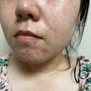 나나스킨 콤플렉스씨쓰리닥터클리어앰플 — 4점을 준 리뷰어가 2021년 9월 올린 사용 사진