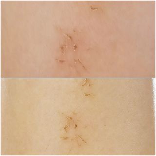 건선/아토/습진/민감성 피부 천연보습진정크림 소리온 크림 & 센시티브 크림 50g — 5점을 준 리뷰어가 2022년 1월 올린 사용 사진