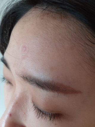 올리브영 엘라밴드 하이드로 도트 스팟패치 12mm, 티트리 — 5점을 준 리뷰어가 2022년 10월 올린 사용 사진
