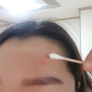 히루스카 포스트아크네 클리어 — 5점을 준 리뷰어가 2021년 1월 올린 사용 사진