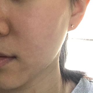 히루스카 포스트아크네 클리어 — 4점을 준 리뷰어가 2021년 1월 올린 사용 사진