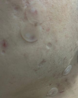 닥터플리너스 제트 큐어 크림 30ml + 제로 트러블 패치 9EA — 3점을 준 리뷰어가 2022년 4월 올린 사용 사진