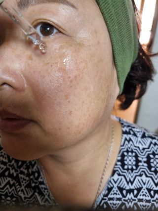 퍼퓸홀릭 [보툴리늄 원액] 7일의 변화 메디-보툴리늄 — 5점을 준 리뷰어가 2021년 9월 올린 사용 사진