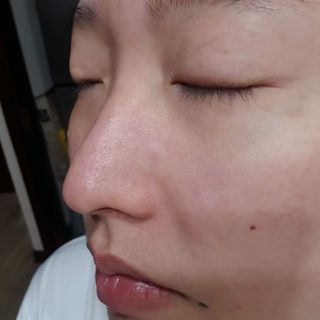 [큐어반H 스팟] 자외선 99프로 차단되는 스틱타입 스팟밴드(1팩 / 66매입) — 5점을 준 리뷰어가 2022년 12월 올린 사용 사진