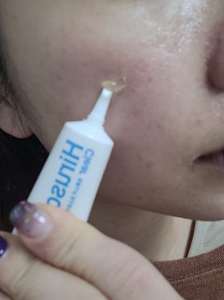 히루스카 포스트아크네 클리어 — 5점을 준 리뷰어가 2021년 1월 올린 사용 사진