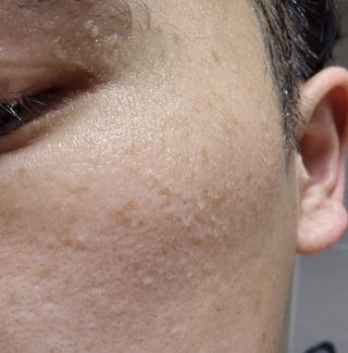 팜스테이 티트리 바이옴 카밍 아크네 폼 — 5점을 준 리뷰어가 2022년 5월 올린 사용 사진