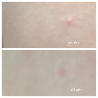 세뚜아(Cettua) 세뚜아 스팟 클리어 듀얼 패치 Cettua Spot Clear Dual Patch — 5점을 준 리뷰어가 2023년 7월 올린 사용 사진