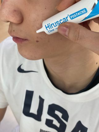히루스카 포스트아크네 클리어 — 4점을 준 리뷰어가 2021년 1월 올린 사용 사진