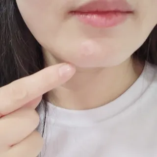 [큐어반H 스팟] 자외선 99프로 차단되는 스틱타입 스팟밴드(1팩 / 66매입) — 5점을 준 리뷰어가 2022년 12월 올린 사용 사진
