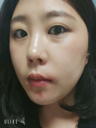 냉장고에 넣어요, 붉은 트러블 피부 다음날 진정되요 [버진팜스 푸딩수딩아토] — 5점을 준 리뷰어가 2021년 9월 올린 사용 사진