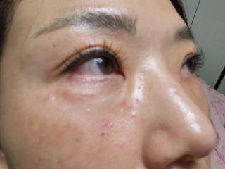 올리브영 엘라밴드 하이드로 도트 스팟패치 12mm, 티트리 — 5점을 준 리뷰어가 2022년 9월 올린 사용 사진