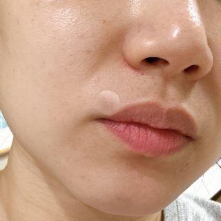 3M 넥스케어 블레미쉬 여드름패치 릴리프 111매(짜기 전 케어) +알코올스왑 증정 — 5점을 준 리뷰어가 2024년 5월 올린 사용 사진