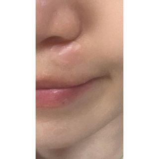 마이디플러스 트러블 릴리프 케어 마이크로 패치 1박스 2매 — 5점을 준 리뷰어가 2021년 11월 올린 사용 사진