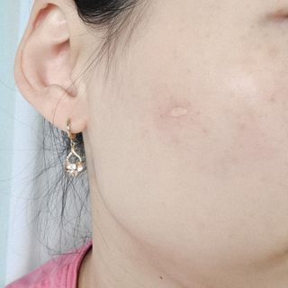 히루스카 포스트아크네 클리어 — 5점을 준 리뷰어가 2021년 1월 올린 사용 사진