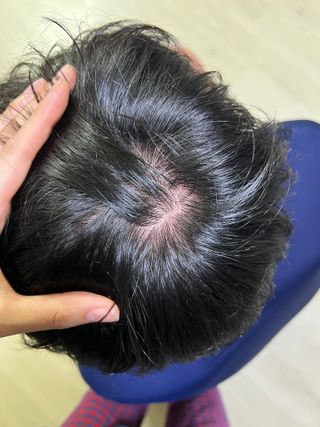 닥터시드 티트리 앤 라임 비건 지성케어 쿨 탈모 두피 워터 스케일러 — 5점을 준 리뷰어가 2024년 4월 올린 사용 사진
