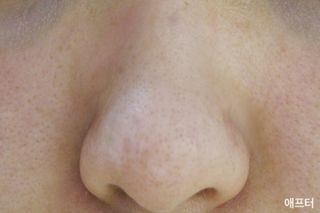 세뚜아(Cettua) 세뚜아 스티키 포어 패치 Cettua Sticky Pore Patch — 5점을 준 리뷰어가 2023년 9월 올린 사용 사진