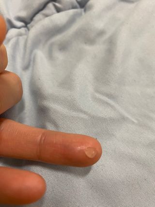 히루스카 포스트아크네 클리어 — 5점을 준 리뷰어가 2020년 12월 올린 사용 사진