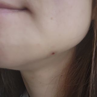 3M 넥스케어 블레미쉬 여드름패치 릴리프 111매(짜기 전 케어) +알코올스왑 증정 — 5점을 준 리뷰어가 2024년 7월 올린 사용 사진