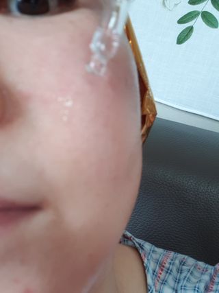 퍼퓸홀릭 [보툴리늄 원액] 7일의 변화 메디-보툴리늄 — 5점을 준 리뷰어가 2021년 9월 올린 사용 사진