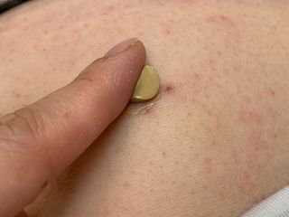 건선/아토/습진/민감성 피부 천연보습진정크림 소리온 크림 & 센시티브 크림 50g — 4.5점을 준 리뷰어가 2022년 3월 올린 사용 사진