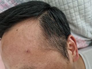 빅그린 프리미어 바이옴 앰플팩 - 두피탈모관리용 — 5점을 준 리뷰어가 2022년 12월 올린 사용 사진