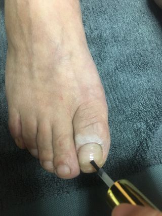 유케어 YOU CARE 문제성 손발톱케어_럭키풋 — 5점을 준 리뷰어가 2022년 10월 올린 사용 사진