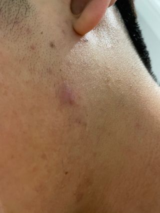 히루스카 포스트아크네 클리어 — 5점을 준 리뷰어가 2021년 2월 올린 사용 사진