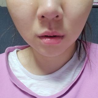 메디미케이알 커핑테라피 실리콘부항마사지 리프팅 페이스+바디 안티 셀룰 라이트 6pcs — 4점을 준 리뷰어가 2021년 2월 올린 사용 사진