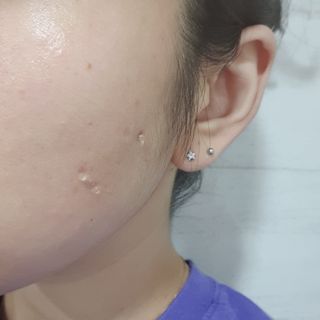 히루스카 포스트아크네 클리어 — 5점을 준 리뷰어가 2020년 12월 올린 사용 사진