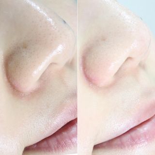 [아벨루나] 모공고민 싹 빨아들이는 홈 뷰티 디바이스 아쿠아필링기 아벨루나 M-200 — 5점을 준 리뷰어가 2021년 6월 올린 사용 사진