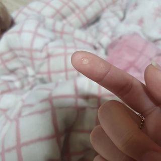 히루스카 포스트아크네 클리어 — 4점을 준 리뷰어가 2020년 12월 올린 사용 사진