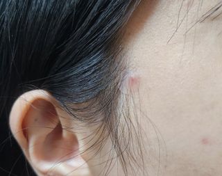 [큐어반H 스팟] 자외선 99프로 차단되는 스틱타입 스팟밴드(1팩 / 66매입) — 5점을 준 리뷰어가 2022년 12월 올린 사용 사진