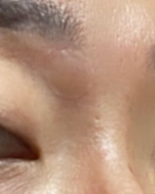 올리브영 엘라밴드 하이드로 도트 스팟패치 12mm, 티트리 — 5점을 준 리뷰어가 2022년 9월 올린 사용 사진