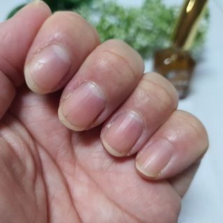 유케어 YOU CARE 문제성 손발톱케어_럭키풋 — 5점을 준 리뷰어가 2022년 10월 올린 사용 사진