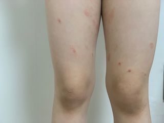 건선/아토/습진/민감성 피부 천연보습진정크림 소리온 크림 & 센시티브 크림 50g — 5점을 준 리뷰어가 2022년 1월 올린 사용 사진