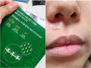 마이디플러스 트러블 릴리프 케어 마이크로 패치 1박스 2매 — 4.5점을 준 리뷰어가 2021년 11월 올린 사용 사진