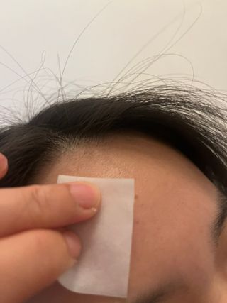3M 넥스케어 블레미쉬 여드름패치 릴리프 111매(짜기 전 케어) +알코올스왑 증정 — 5점을 준 리뷰어가 2024년 7월 올린 사용 사진