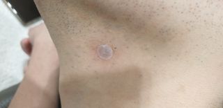 [큐어반H 스팟] 자외선 99프로 차단되는 스틱타입 스팟밴드(1팩 / 66매입) — 4점을 준 리뷰어가 2022년 11월 올린 사용 사진
